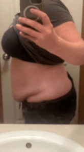 After Image: Body Contouring