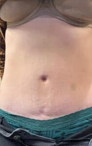 After Image: Body Contouring