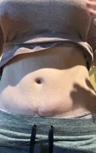 Before Image: Body Contouring