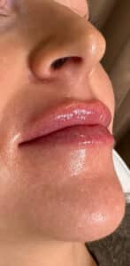 After Image: Lip Filler