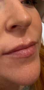 Before Image: Lip Filler