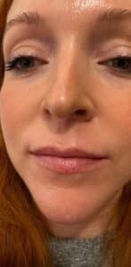 Before Image: Lip Filler