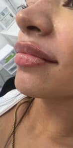 After Image: Lip Filler