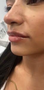 Before Image: Lip Filler