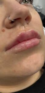 After Image: Lip Filler