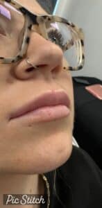 Before Image: Lip Filler